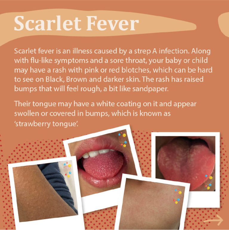 Scarlet Fever