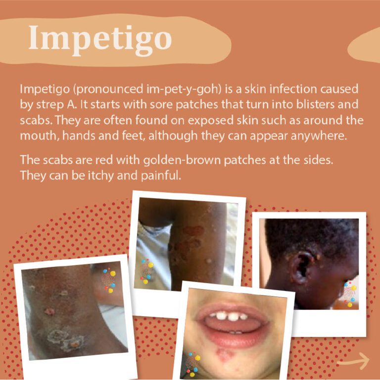 Impetigo