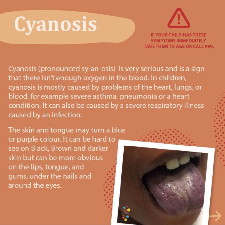 Cyanosis